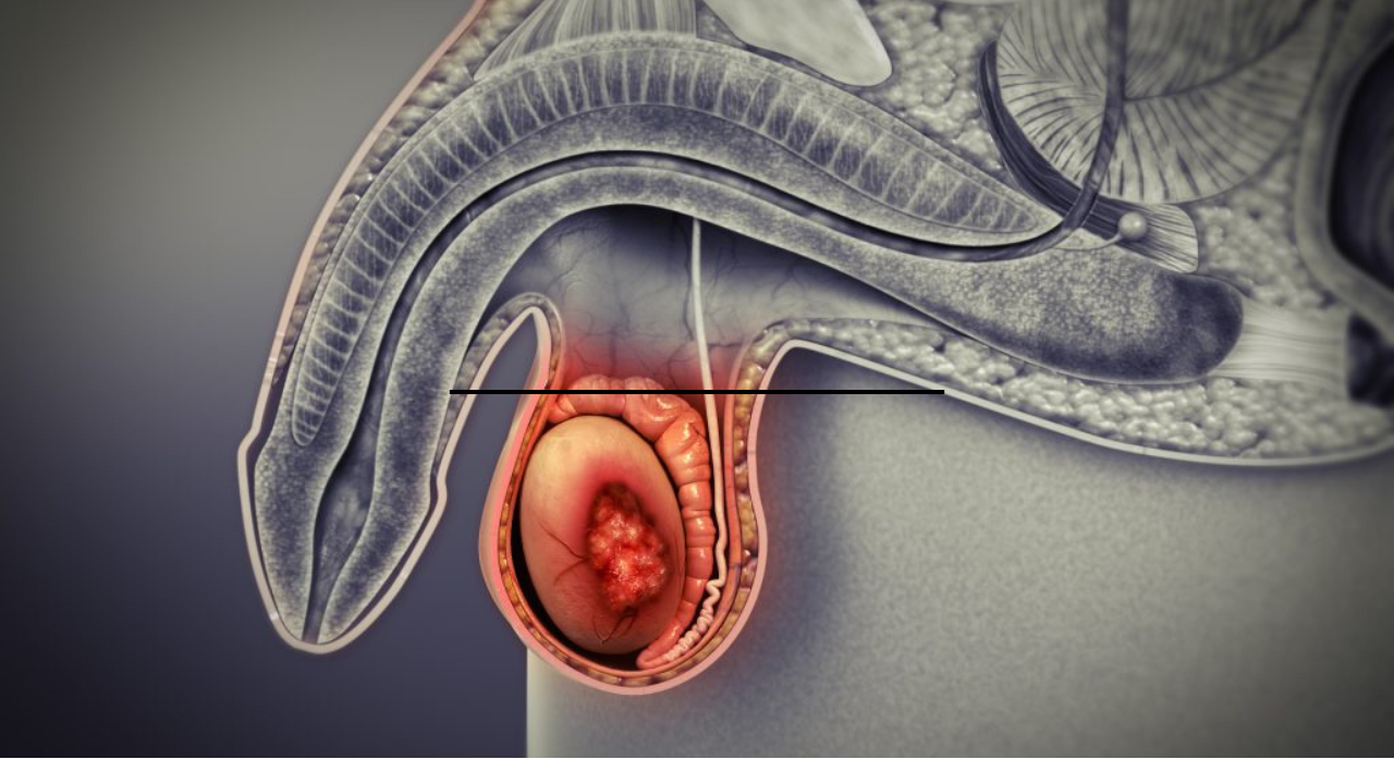 El cáncer testicular se origina en los testículos, que son las glándulas encargadas de producir esperma y testosterona.
