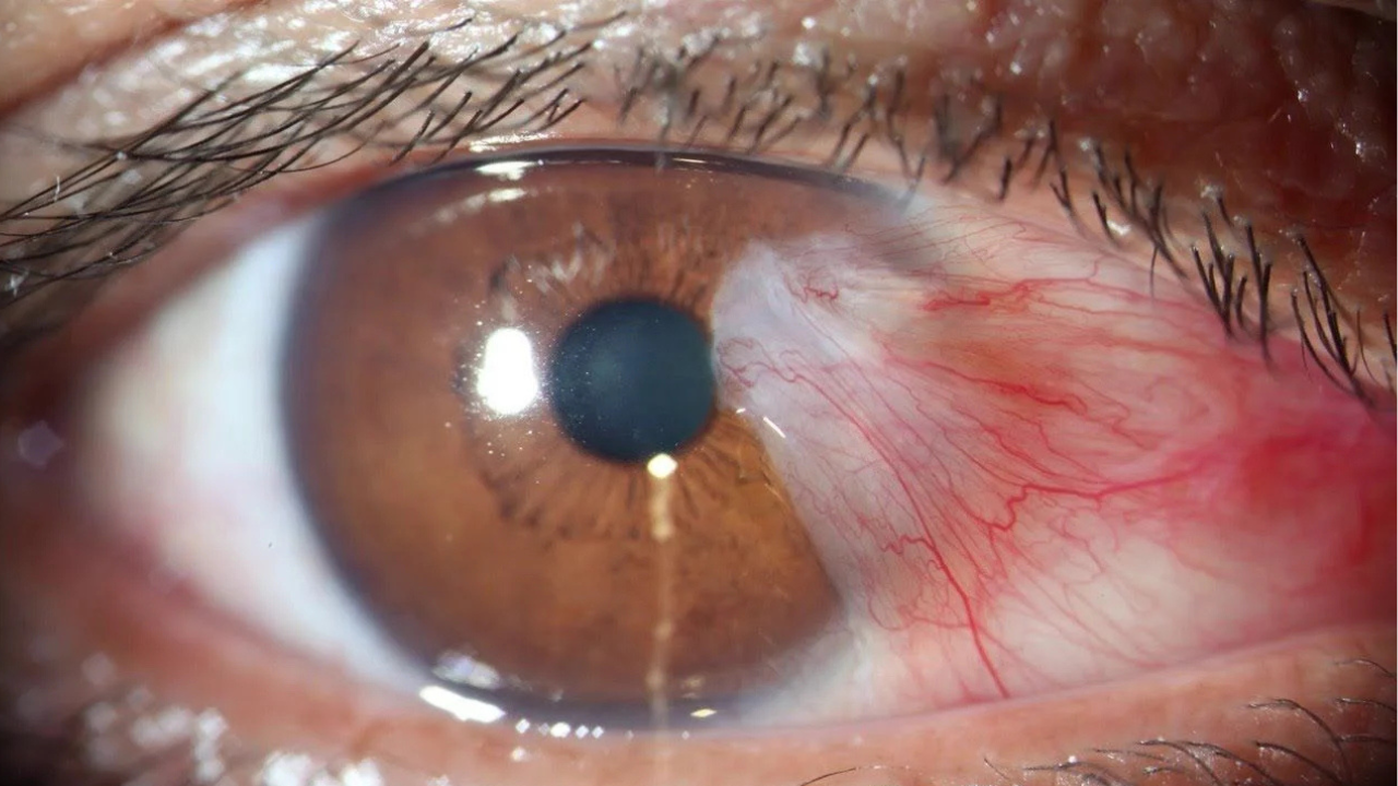 Las cataratas oculares se producen cuando el cristalino, la lente natural del ojo, pierde su transparencia y se vuelve opaco.