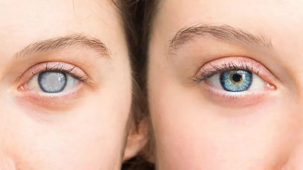 ¿Ves borroso últimamente? Podrían ser cataratas en los ojos: descubre qué son y cómo se tratan.