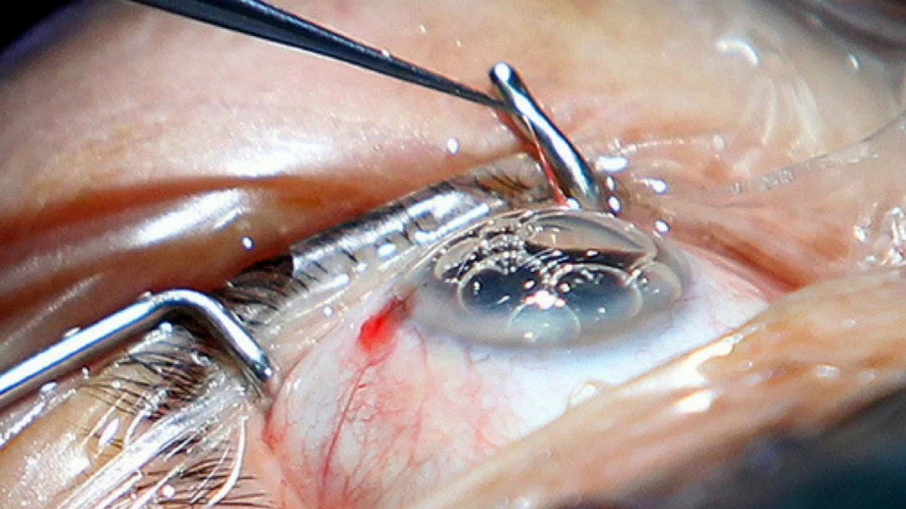 El único tratamiento eficaz para las cataratas es la cirugía, en la que se retira el cristalino opaco y se reemplaza por una lente intraocular artificial.