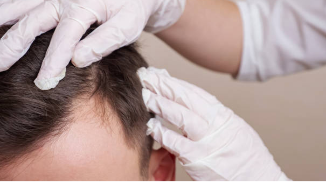 Dermatitis Seborreica: Tratamientos eficaces y consejos para eliminarla.