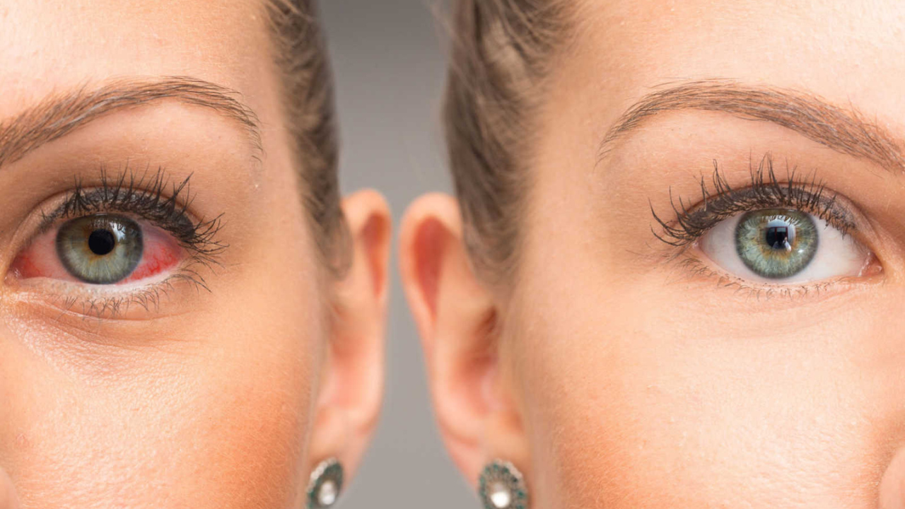 ¿Qué es el glaucoma ocular y por qué debes detectarlo a tiempo?
