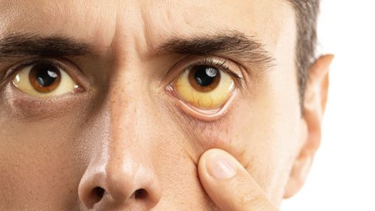 Ictericia. El tono amarillento en la piel o en los ojos es uno de los síntomas más visibles de que algo no anda bien con tu hígado.