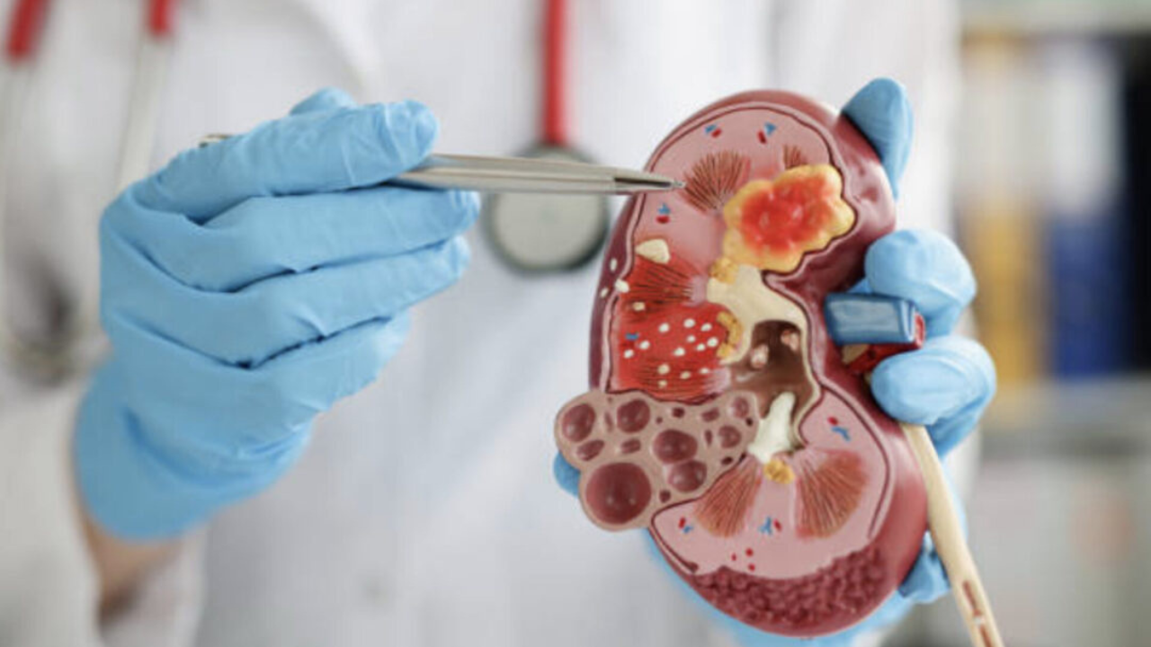 Acudir al médico a tiempo puede prevenir complicaciones mayores. El diagnóstico temprano es clave para mantener tu salud renal en buen estado.