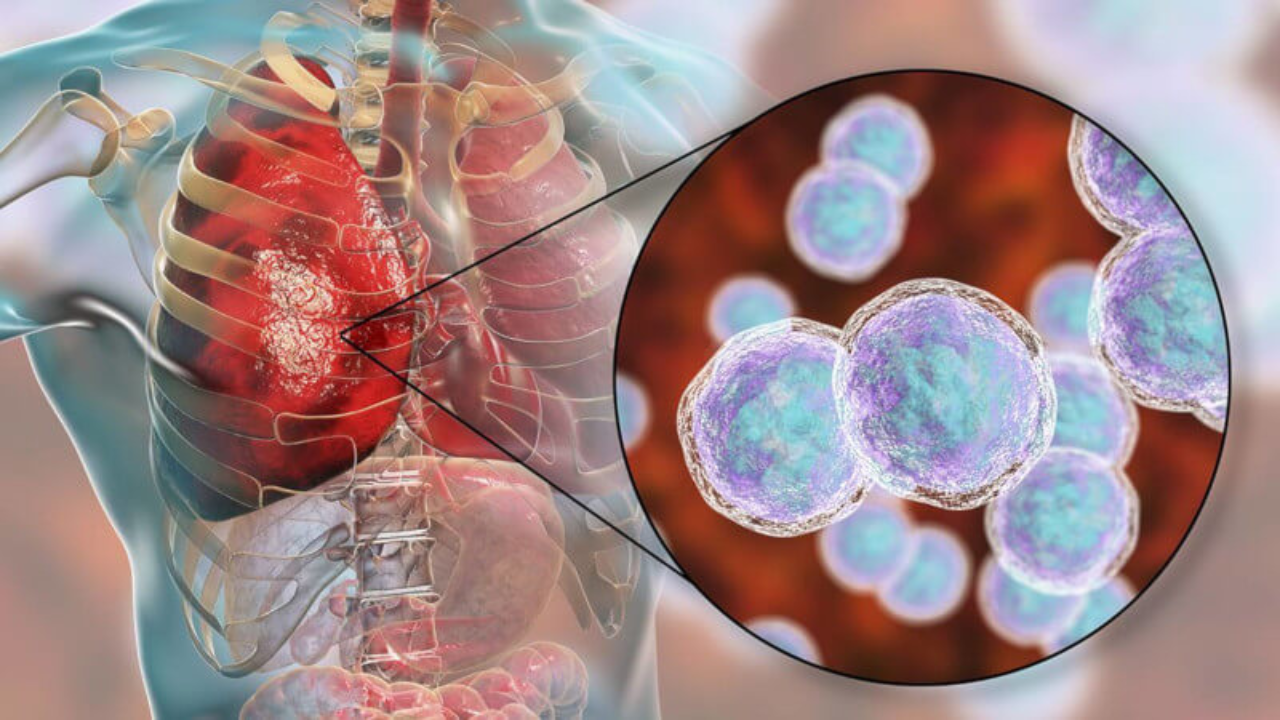 Infecciones respiratorias como la neumonía.