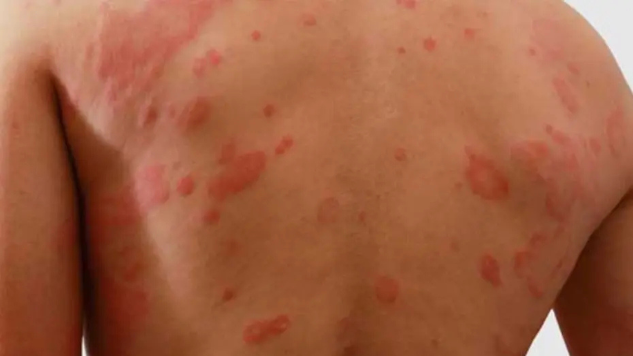 Erupciones cutáneas o urticaria: uno de los síntomas más frecuentes.