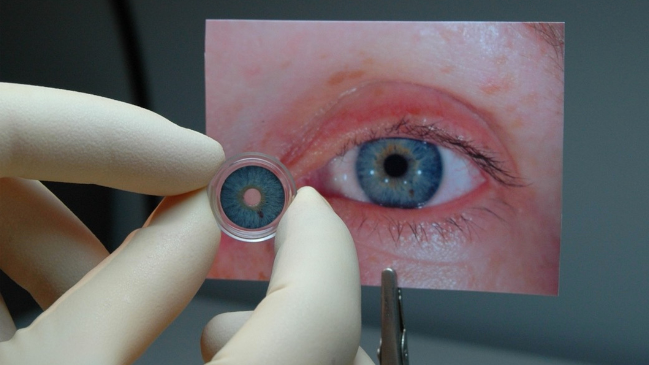 Uno de los métodos más mencionados es la cirugía de implante de iris artificial, en la que se coloca una prótesis sobre el iris natural para dar un nuevo color.