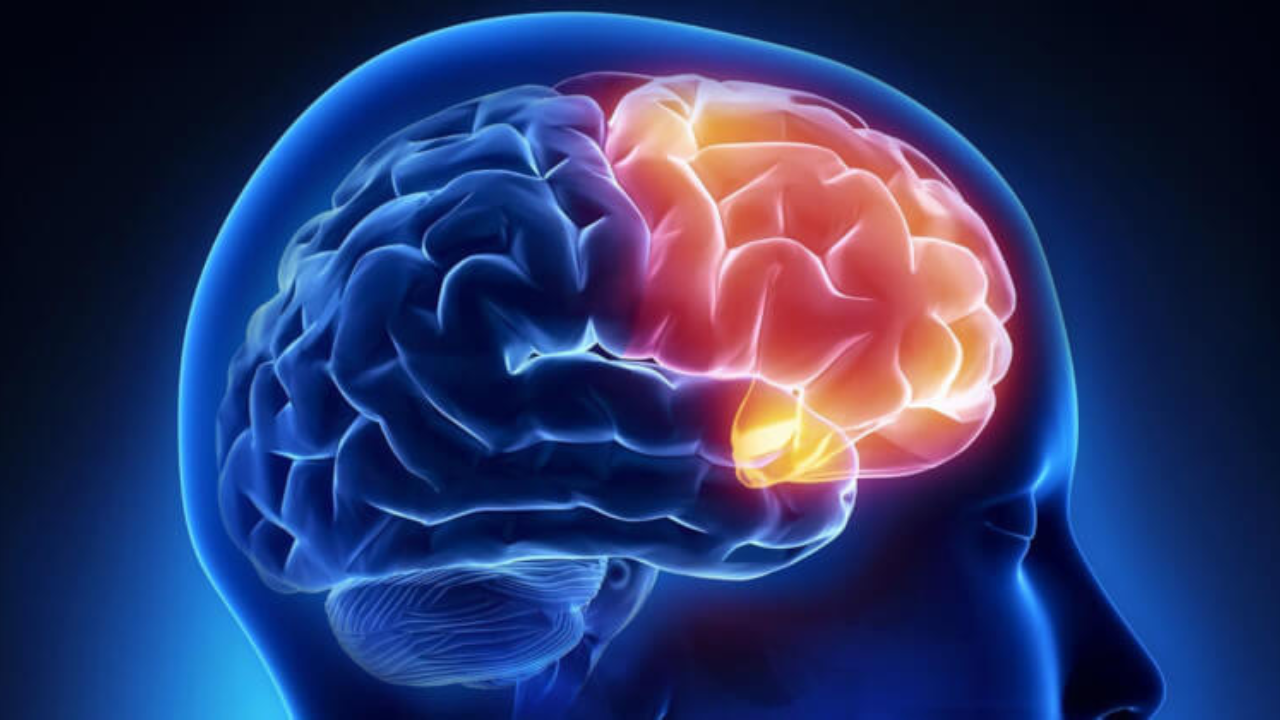 Bruce Willis padece ahora demencia frontotemporal (FTD), una forma rara de demencia que afecta principalmente las zonas frontal y temporal del cerebro.