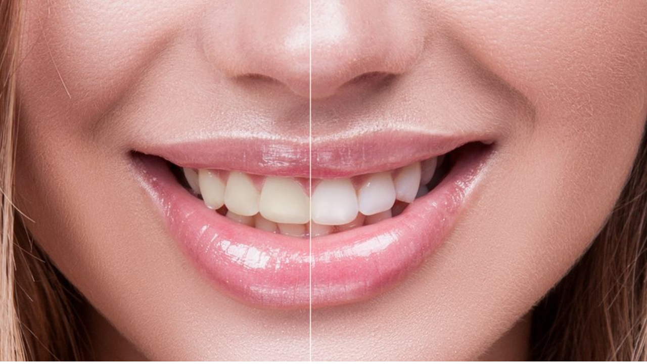 Blanquea tu sonrisa de forma natural: métodos caseros seguros y efectivos.