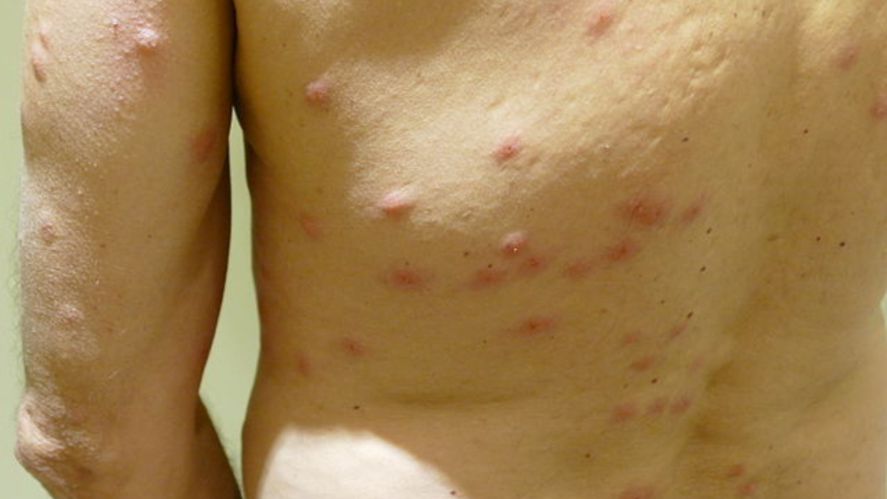 El chiche, también conocido como pulga de arena, tiene un hábito diferente al mosquito. Sus picaduras suelen presentarse en grupos de puntos pequeños y rojizos.