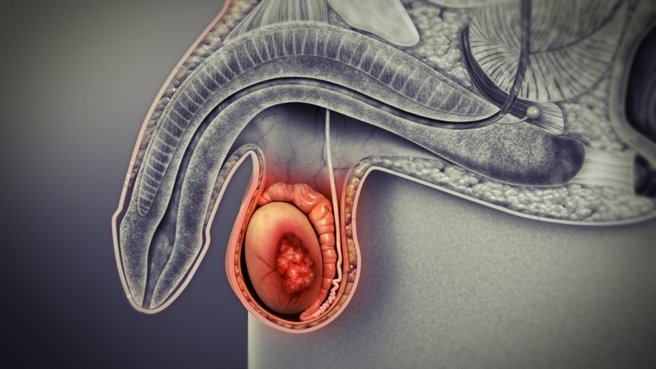 Un estudio caso-control con usuarios de teléfonos celulares no encontró un aumento significativo en el riesgo de cáncer testicular.