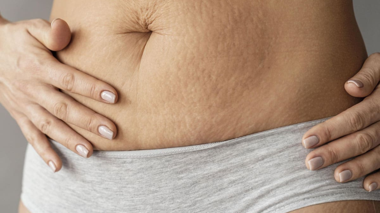 Estrías: ¿Cómo prevenirlas y mantener una piel saludable?