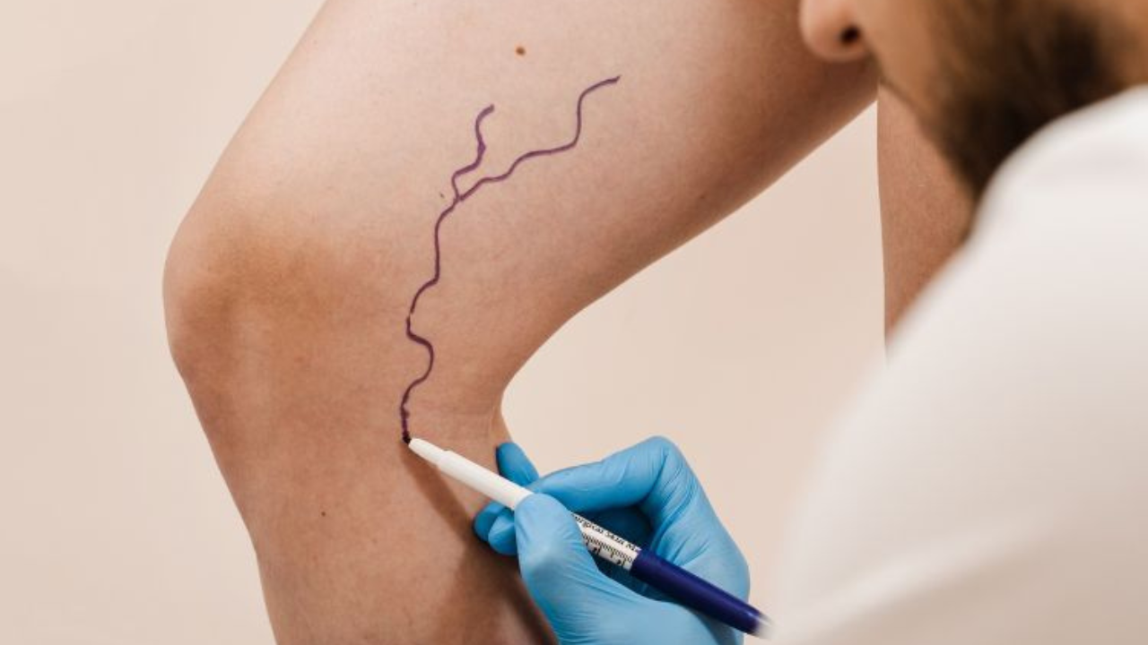 Si tienes antecedentes familiares o factores de riesgo, visitar a un médico especialista en flebología puede ayudarte a identificar medidas preventivas personalizadas.