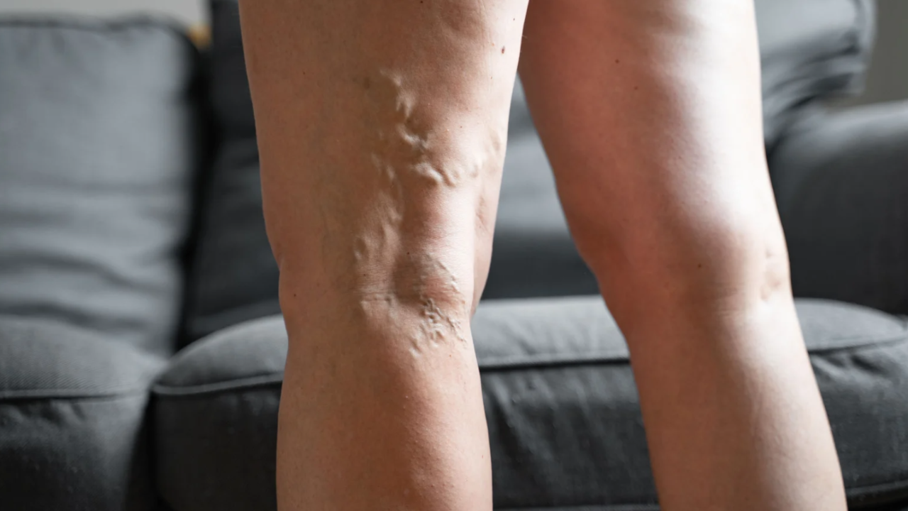 ¿Cómo prevenir las varices en las piernas?: consejos efectivos para cuidar tu circulación